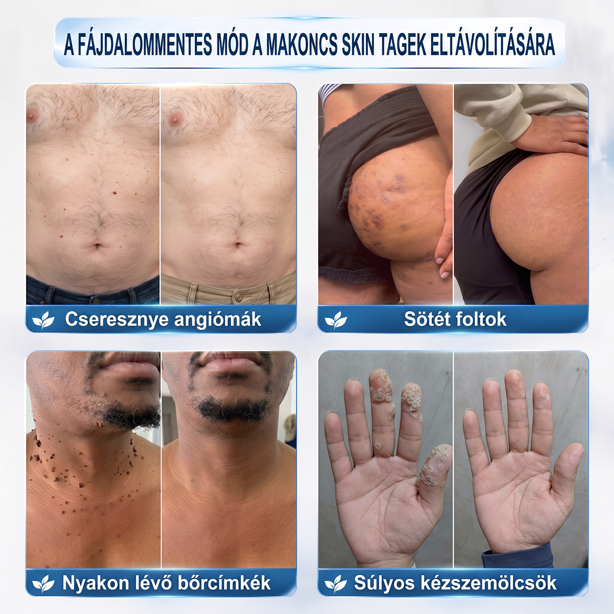🌟HISKIN®👩‍⚕️ 7 napos bőrcimpa- és folteltávolító fájdalommentes, heg nélküli fejlett bőrhibakezelő görgős toll