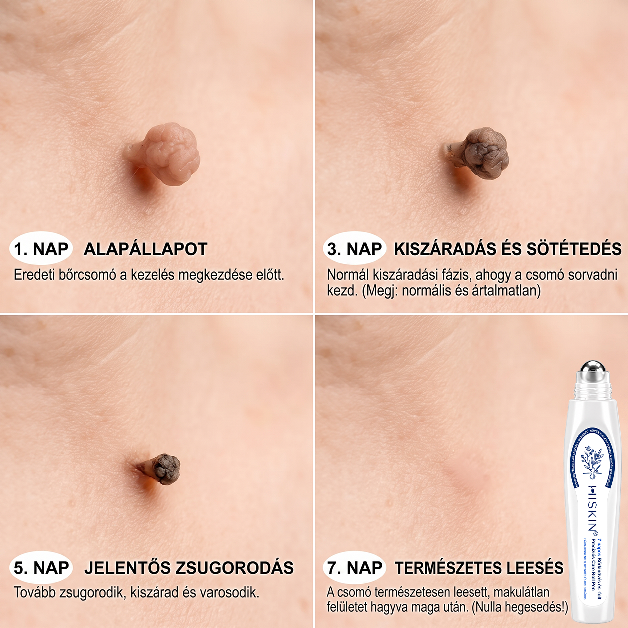 🌟HISKIN®👩‍⚕️ 7 napos bőrcimpa- és folteltávolító fájdalommentes, heg nélküli fejlett bőrhibakezelő görgős toll