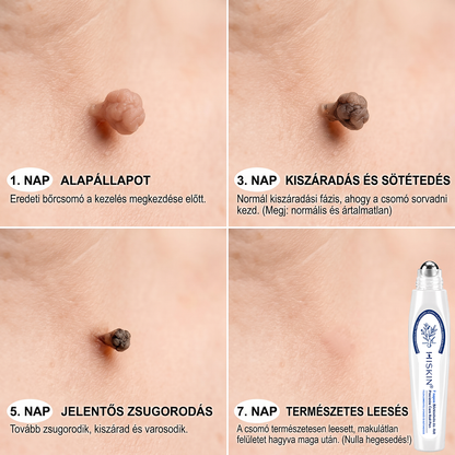 🌟HISKIN®👩‍⚕️ 7 napos bőrcimpa- és folteltávolító fájdalommentes, heg nélküli fejlett bőrhibakezelő görgős toll